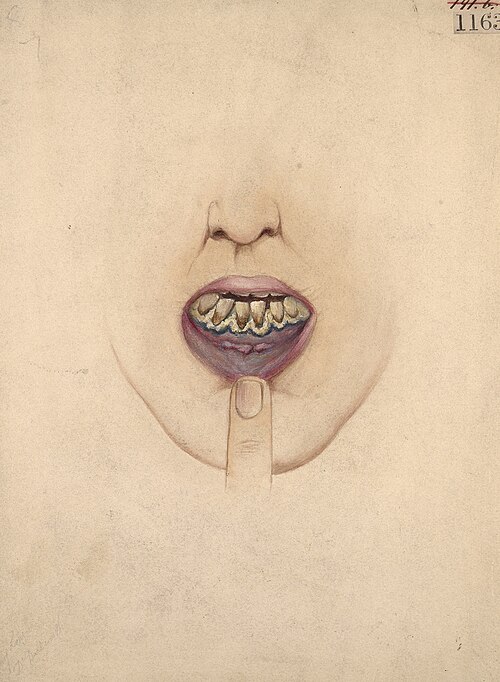 File:Mouth and gums of a lead-mill worker Wellcome L0062322.jpg